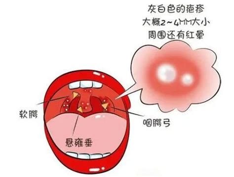 喉嚨長一顆痘痘|喉咙里长了一个痘痘有异物感怎么回事